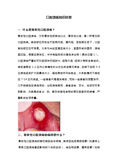 口腔溃疡知识科普