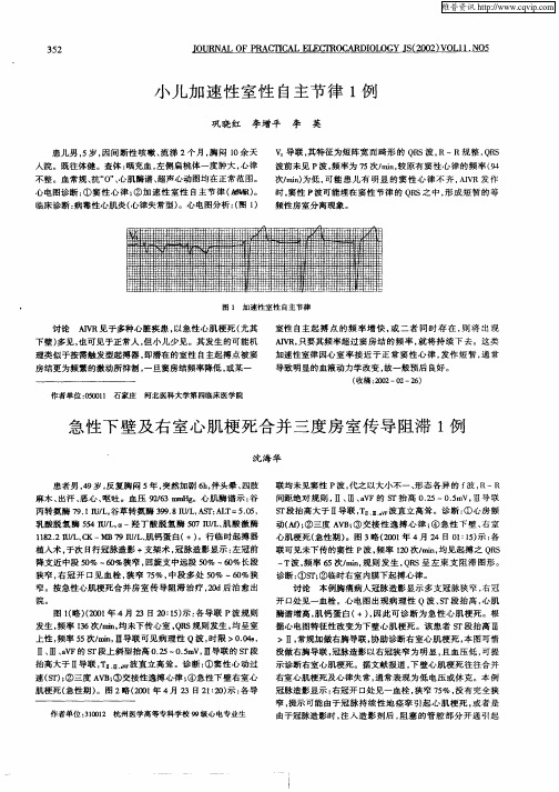 急性下壁及右室心肌梗死合并三度房室传导阻滞1例