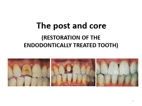 口腔学英文课件：The post and core