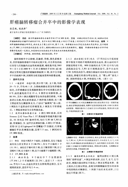 肝癌脑转移瘤合并卒中的影像学表现