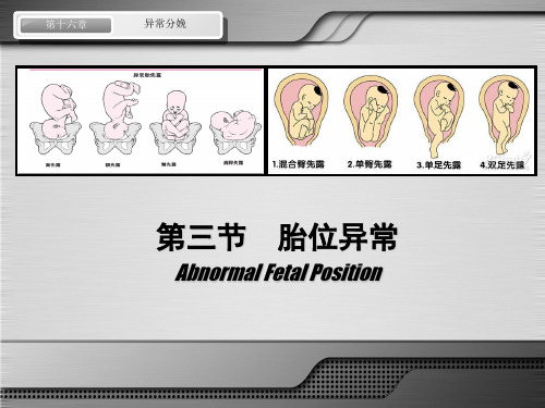 第八版妇产科配套课件-异常分娩-胎位异常