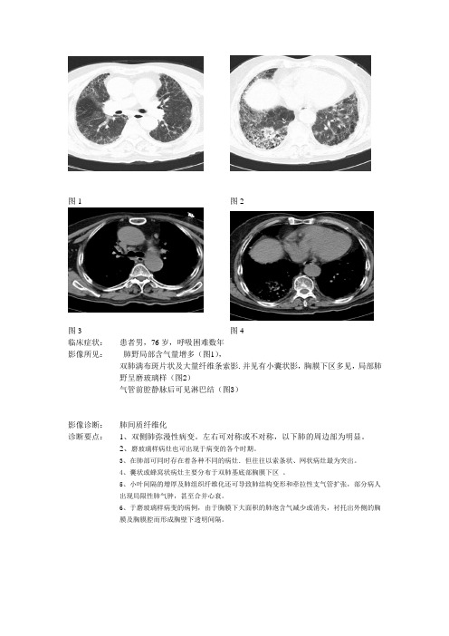 肺间质纤维化