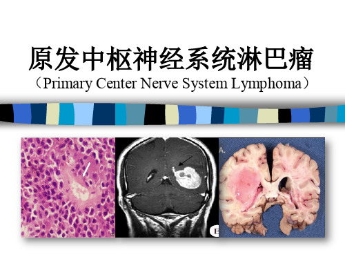 原发中枢神经系统淋巴瘤2018