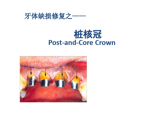 牙体缺损的修复—桩核冠