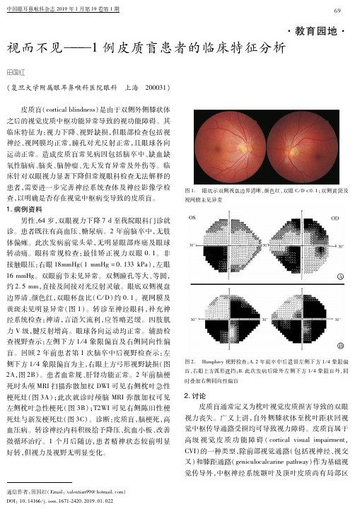 视而不见——1例皮质盲患者的临床特征分析