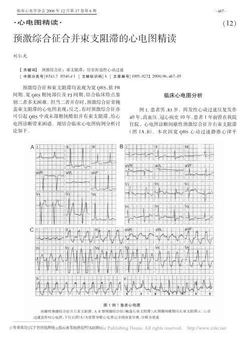 预激综合征合并束支阻滞的心电图精读