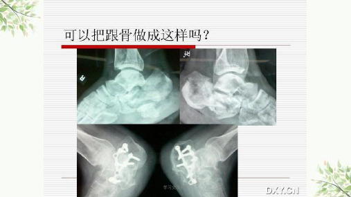 跟骨骨折复位课件