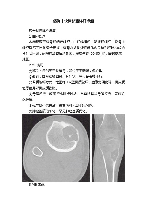 病例｜软骨黏液样纤维瘤