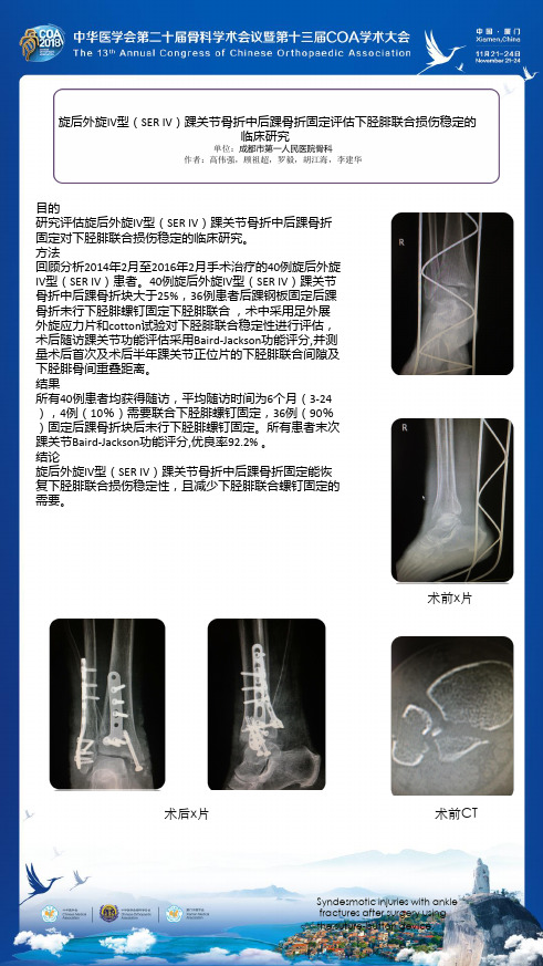 旋后外旋IV型(SER IV)踝关节骨折中后踝骨折固定评估下胫腓联合损伤稳定的