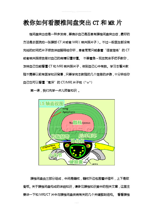 教你如何看腰椎间盘突出CT和MR片