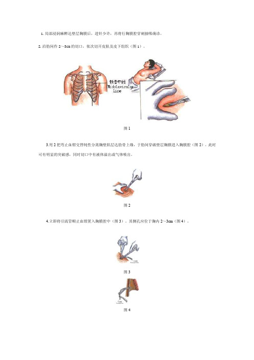 胸腔闭式引流操作说明图