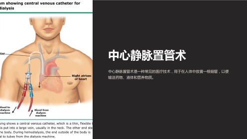 《中心静脉置管术》课件