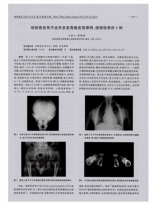颅锁骨发育不全并多发骨骼发育障碍、病理性骨折1例