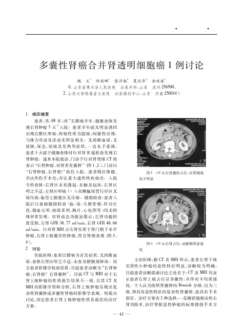 多囊性肾癌合并肾透明细胞癌1例讨论