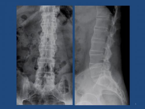 强直性脊柱炎(Ankylosing--Spondylitis-AS)