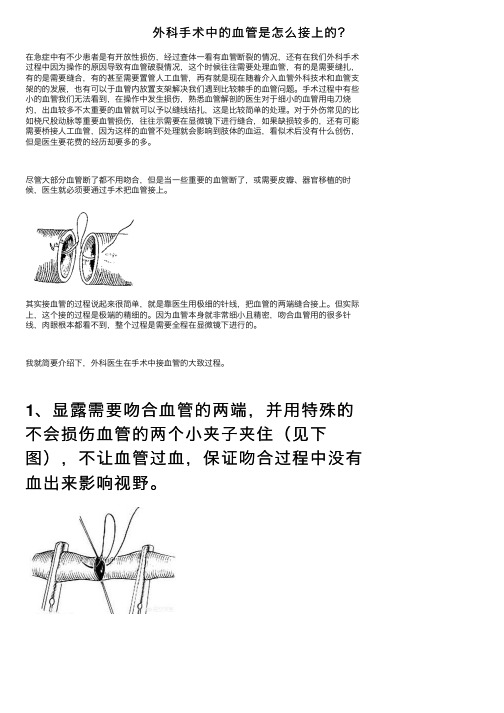 外科手术中的血管是怎么接上的？