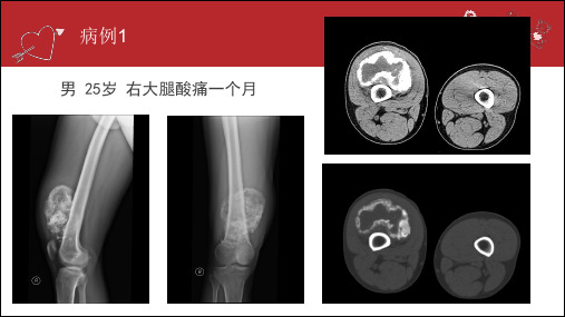 骨软骨瘤的影像表现