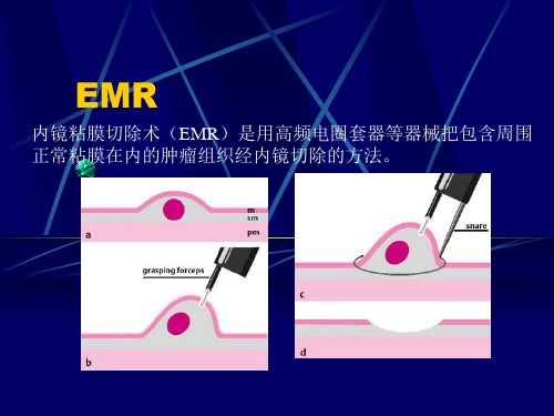 内镜下EMR