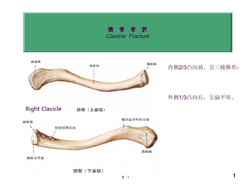 锁骨骨折幻灯片ppt课件