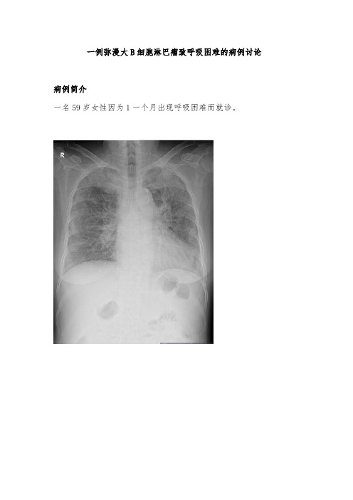 一例弥漫大B细胞淋巴瘤致呼吸困难的病例讨论