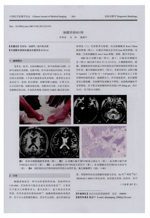 脑腱黄瘤病1例