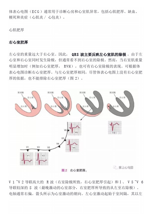 右心室肥厚-基础心电图讲解