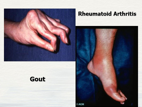 风湿性疾病教学PPT课件