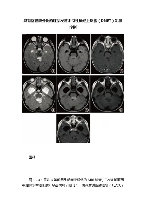 具有室管膜分化的胚胎发育不良性神经上皮瘤（DNET）影像诊断