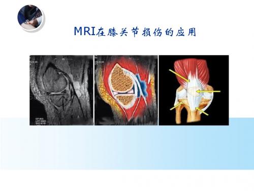 MRI在膝关节损伤的应用