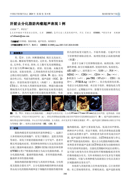 肝脏去分化脂肪肉瘤超声表现1例