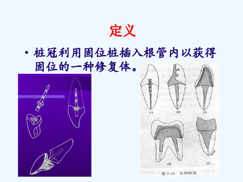 口腔修复学第四章桩核冠