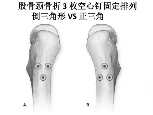 股骨颈空心拉力螺钉排列