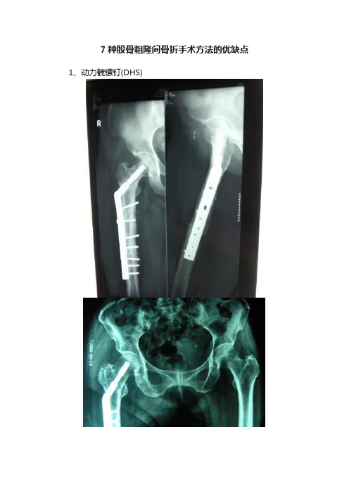 7种股骨粗隆间骨折手术方法的优缺点