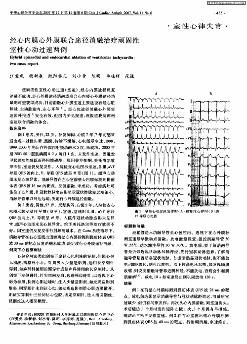 经心内膜心外膜联合途径消融治疗顽固性室性心动过速两例