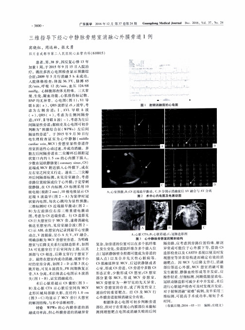 三维指导下经心中静脉旁憩室消融心外膜旁道1例