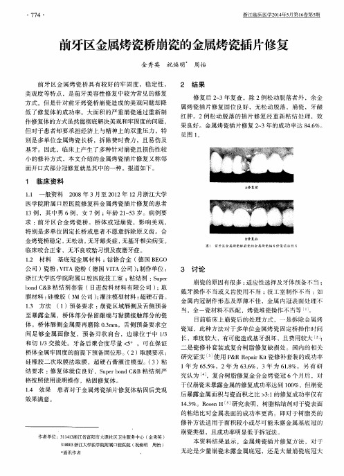 前牙区金属烤瓷桥崩瓷的金属烤瓷插片修复