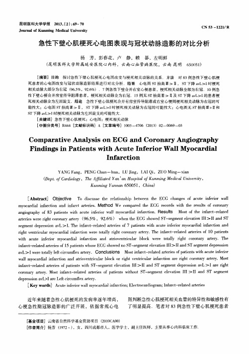 急性下壁心肌梗死心电图表现与冠状动脉造影的对比分析