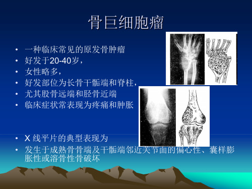 骨巨细胞瘤的治疗