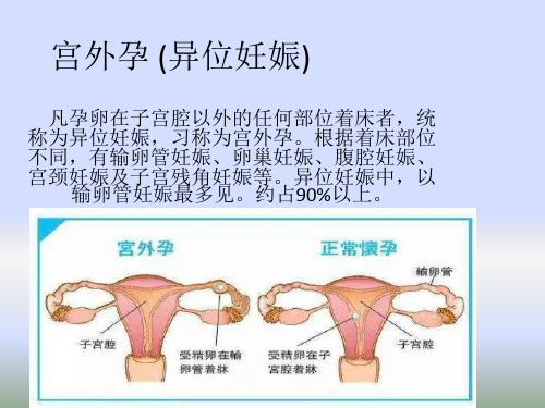 宫外孕PPT