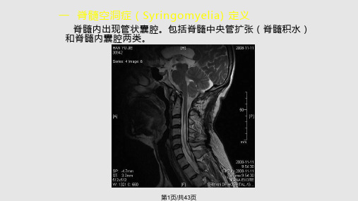 脊髓空洞症临床及影像学表现PPT课件