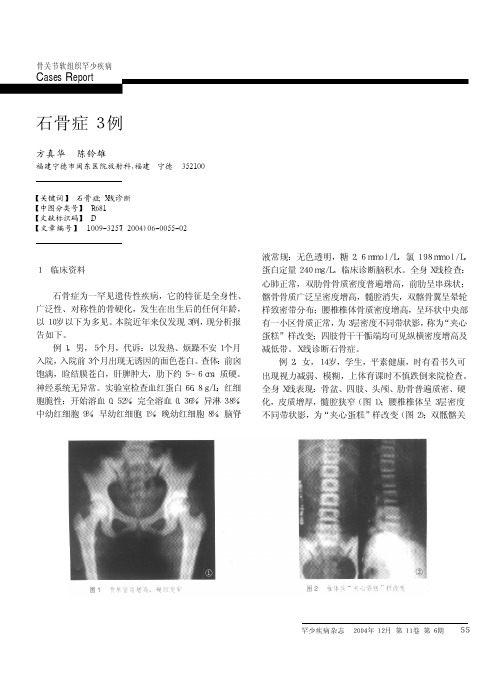 石骨症3例