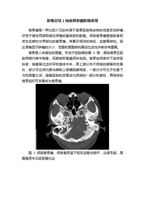 影像总结丨颅底脊索瘤影像表现