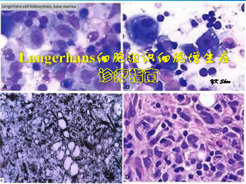 朗格罕细胞组织细胞增生症诊疗指南.
