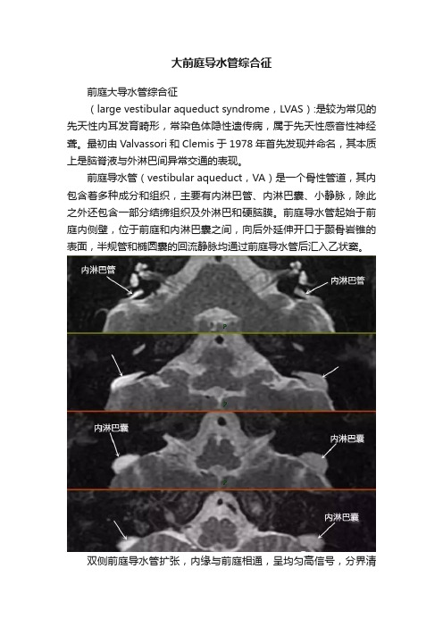 大前庭导水管综合征