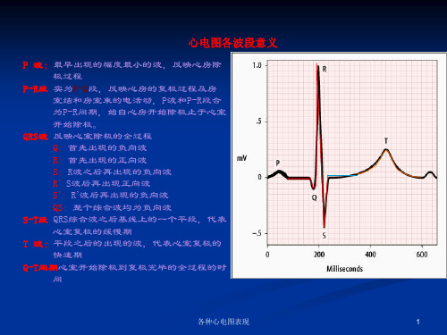 各种心电图表现培训课件