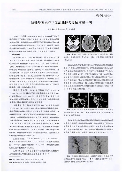 特殊类型永存三叉动脉伴多发脑梗死一例