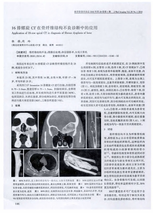 16排螺旋CT在骨纤维结构不良诊断中的应用