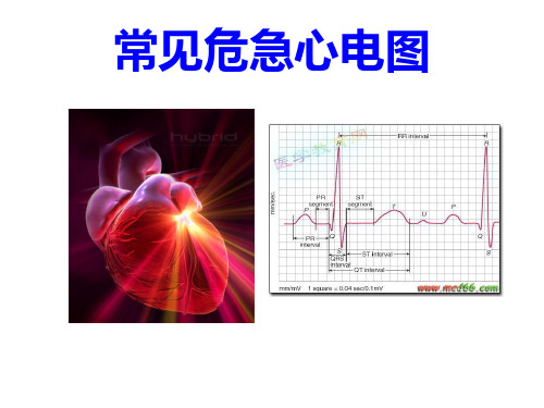 常见危急心电图