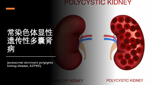 常染色体显性遗传性多囊肾病