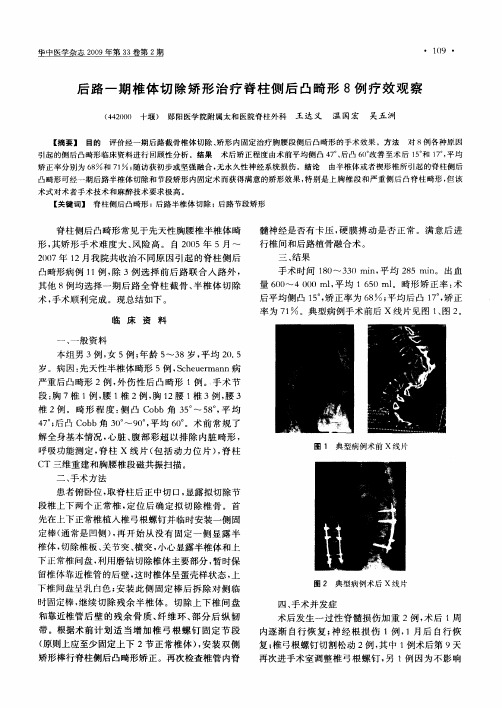 后路一期椎体切除矫形治疗脊柱侧后凸畸形8例疗效观察